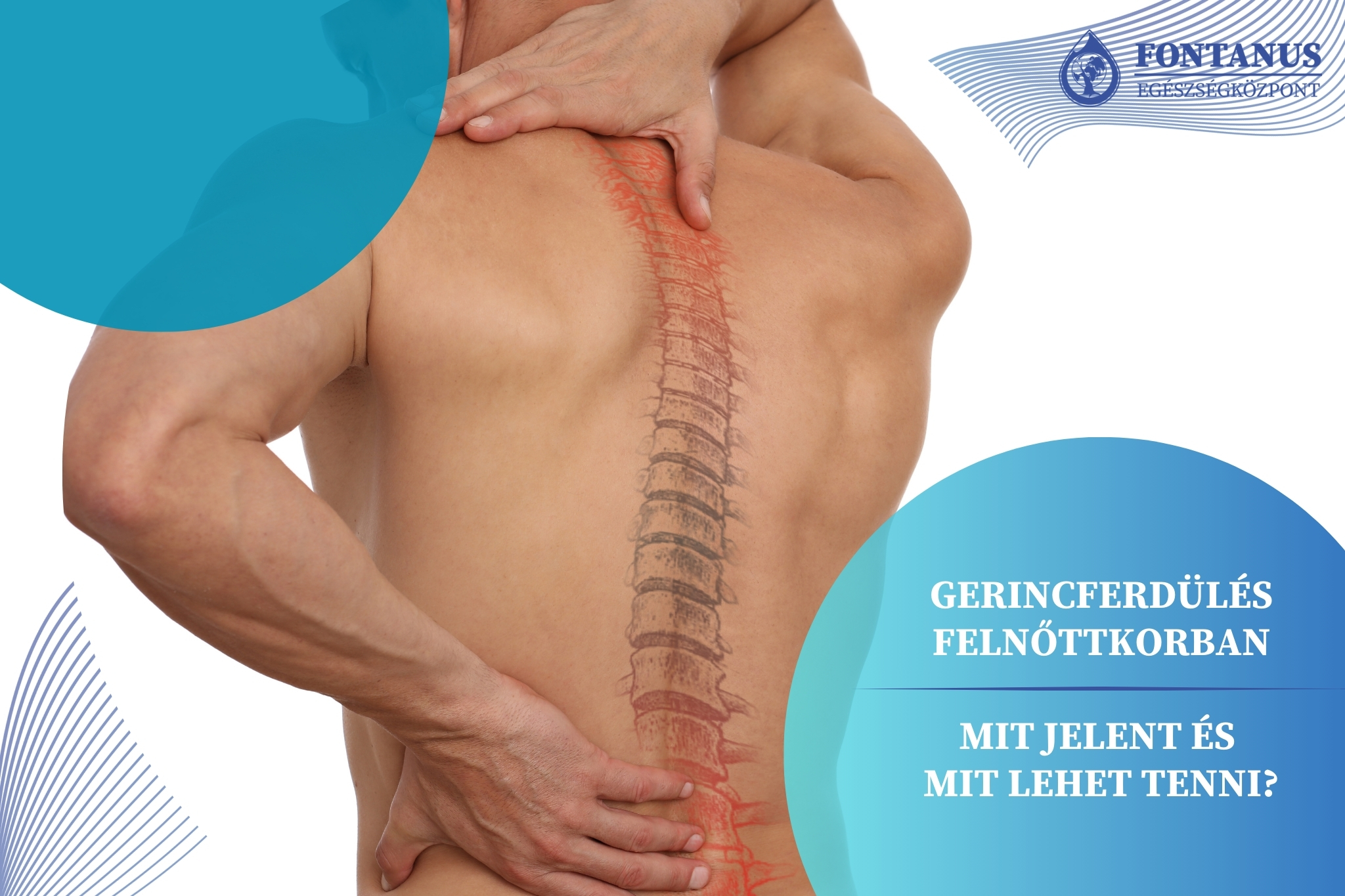 Gerincferdülés felnőttkorban – Mit jelent, és mit lehet tenni?